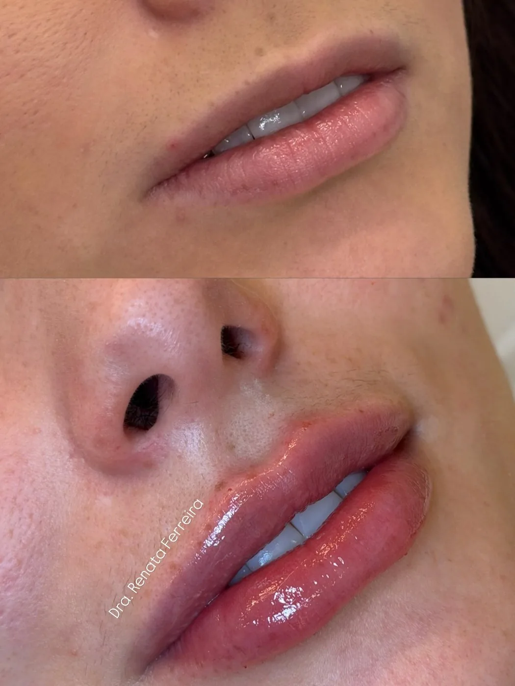 Antes e depois de preenchimento labial.