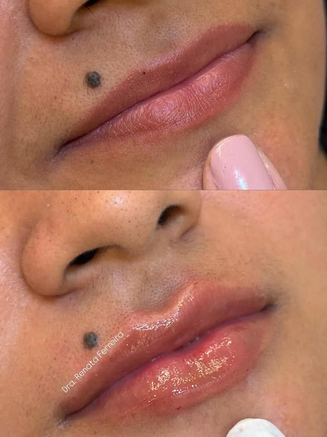 Antes e depois de preenchimento labial.