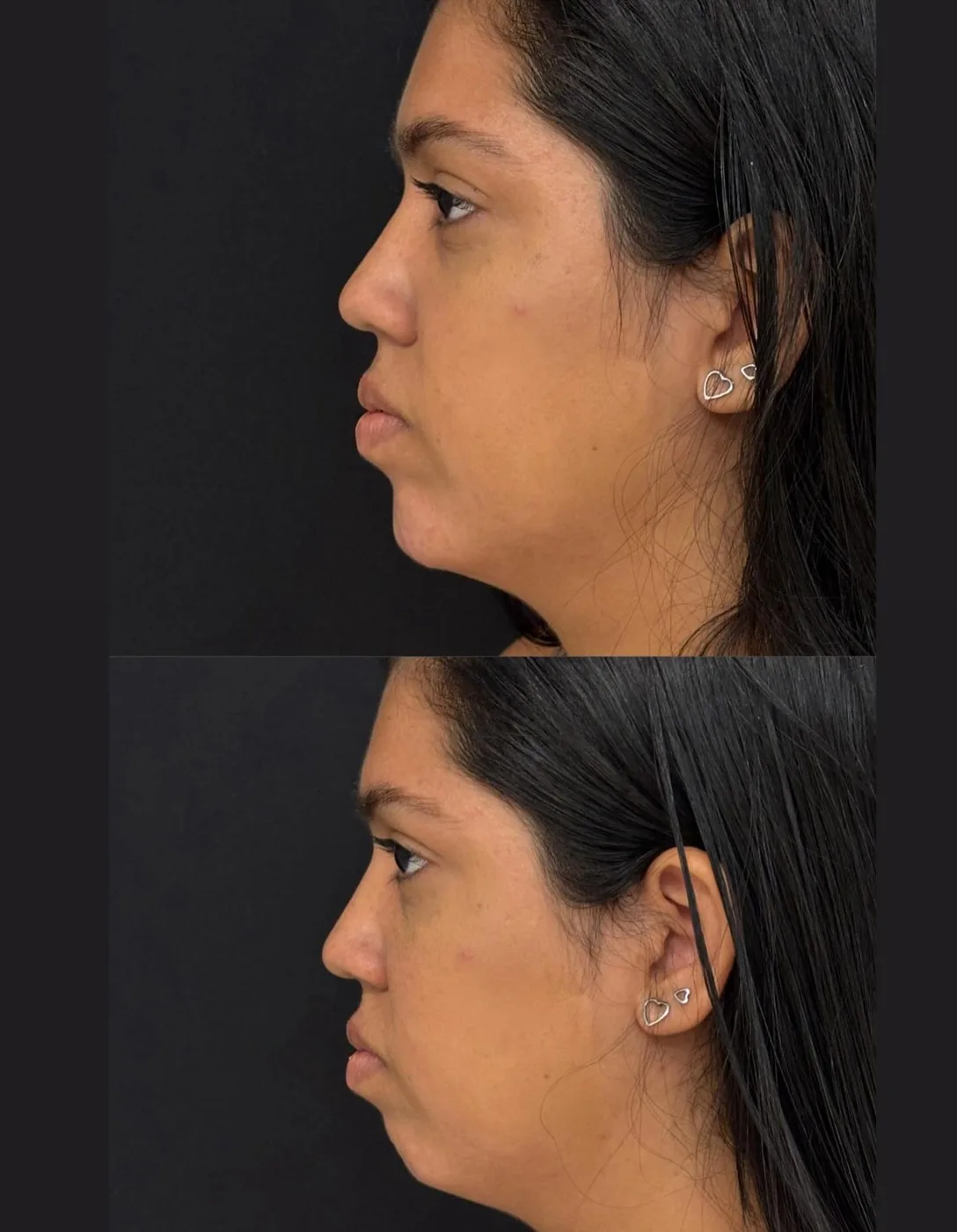 Antes e depois de harmonização do perfil.