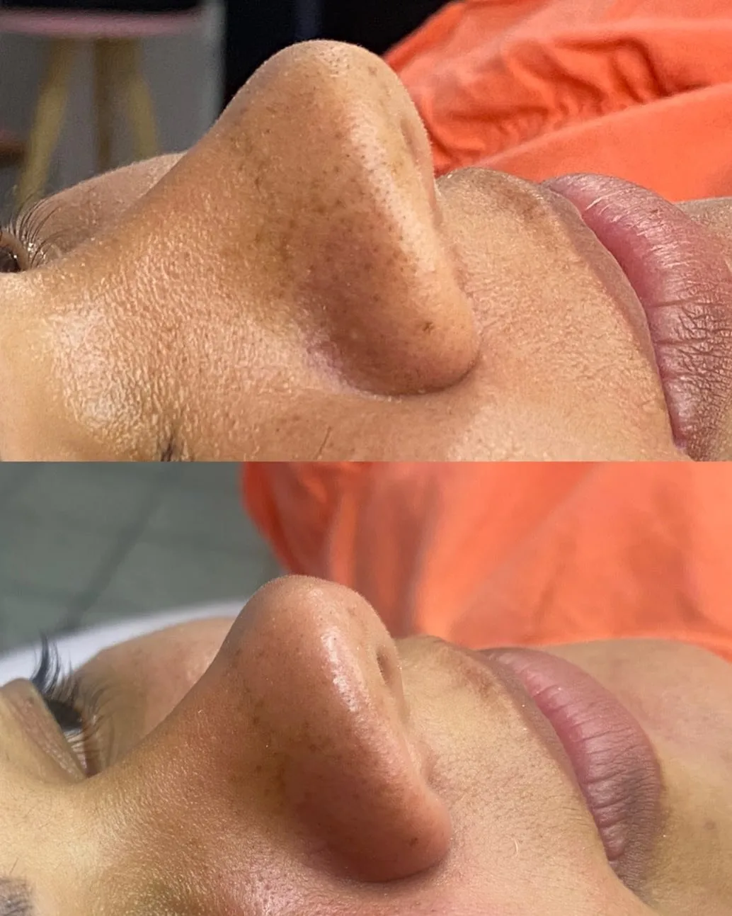 Antes e depois de rinomodelação.