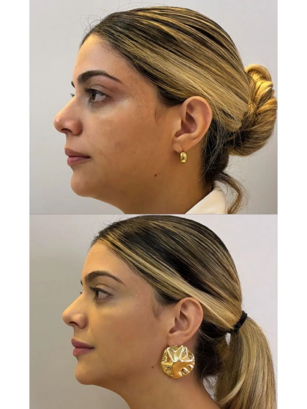 Antes e depois de contorno de mandíbula e mento.