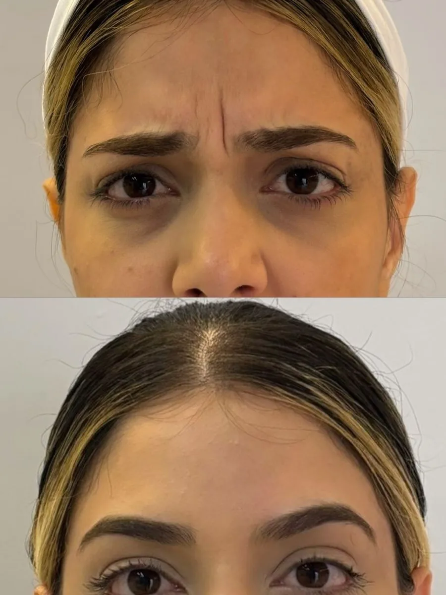 Antes e depois de toxina botulínica na testa.
